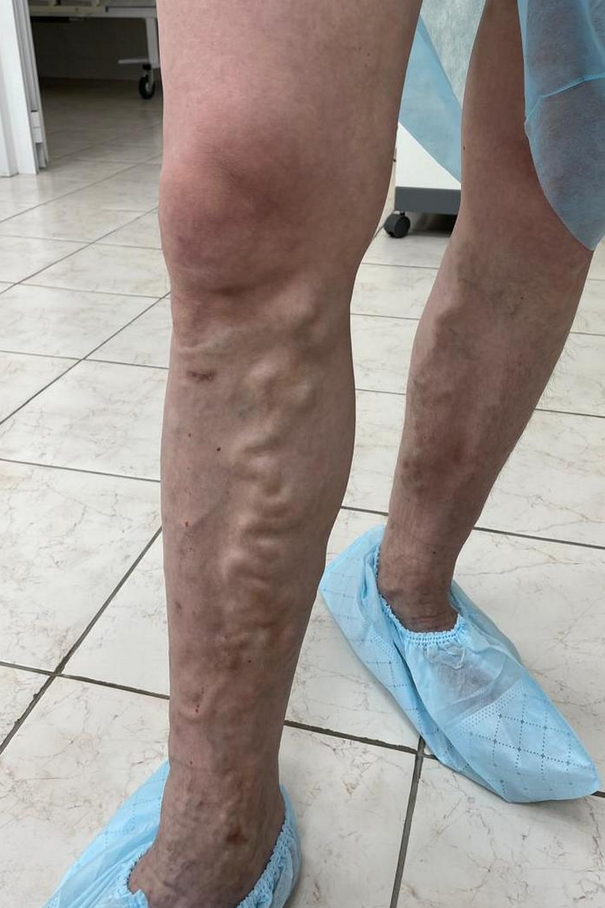 До операции